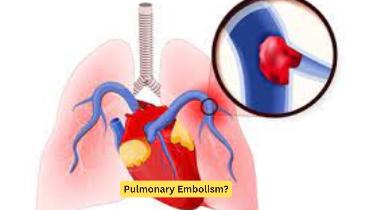 Pulmonary Embolism